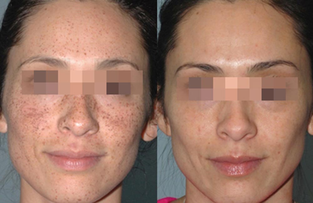 anti-aging-skin-care-laser-therapy-ipl-lumecca-brookfield-wi anti-aging-skin-care-laser-therapy-ipl-lumecca-brookfield-wi
