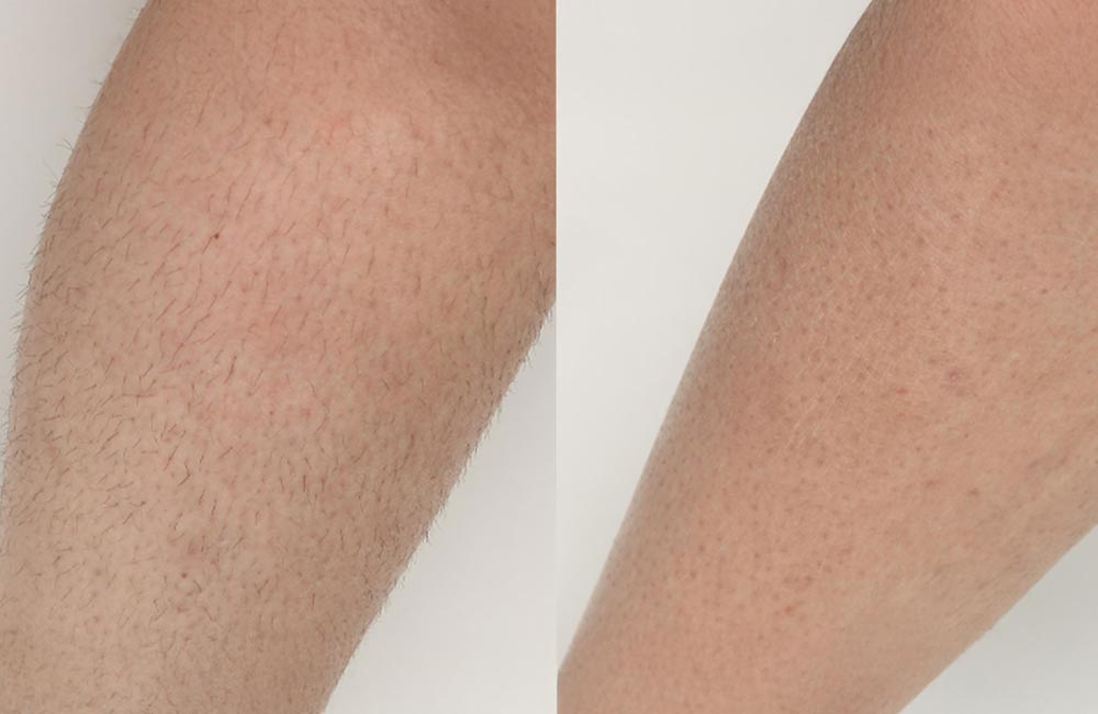 laser-hair-removal-anti-aging-skin-treatments-brookfield-wi laser-hair-removal-anti-aging-skin-treatments-brookfield-wi