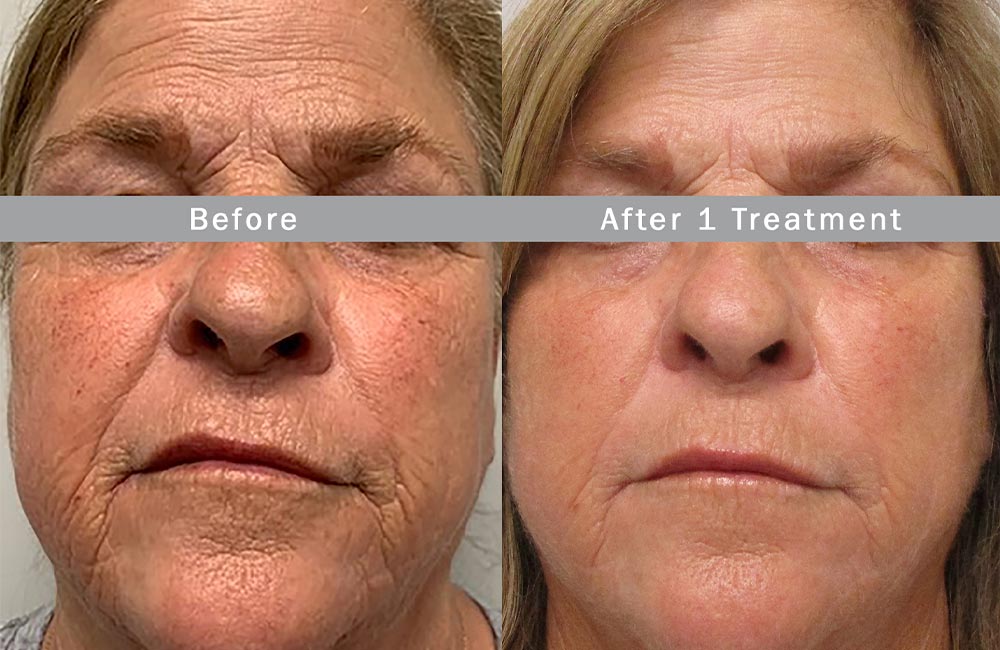 microneedling-anti-aging-skin-treatments-brookfield-wi