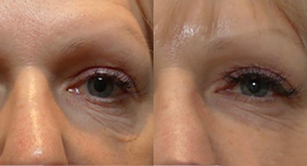 anti-aging-med-spa-brookfield_anti-aging-skin-care-microneedling-skin-therapy-brookfield-wi