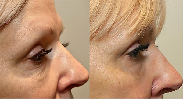 anti-aging-skin-care-microneedling-skin-therapy-brookfield-wi-forley