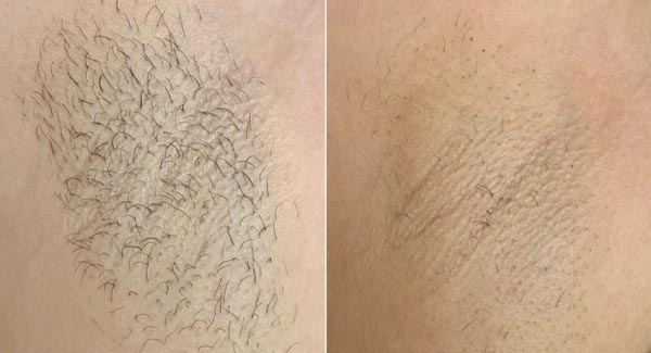diolaze-hair-removal-brookfield-wi_laser-hair-removal--- diolaze-hair-removal-brookfield-wi_laser-hair-removal