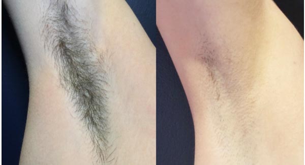 diolaze-hair-removal-brookfield-wi_laser-hair-removal- diolaze-hair-removal-brookfield-wi_laser-hair-removal-