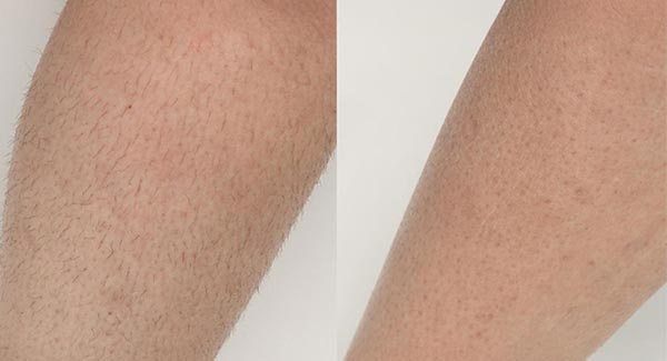 diolaze-hair-removal-brookfield-wi_laser-hair-removal diolaze-hair-removal-brookfield-wi_laser-hair-removal