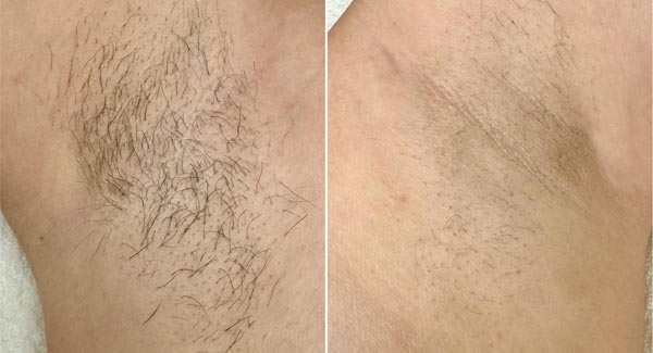 diolaze-hair-removal-brookfield-wi_laser--hair--removal diolaze-hair-removal-brookfield-wi_laser--hair--removal