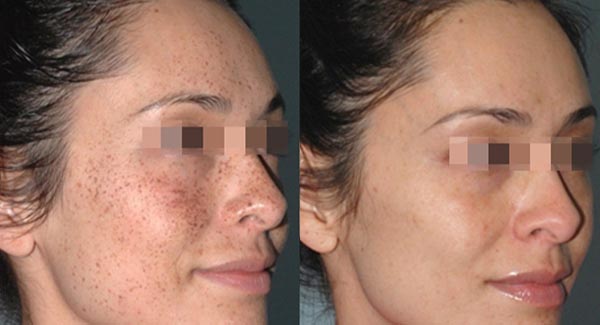 laser-therapy-anti-aging-skincare-brookfield-wi_anti-aging-skin-care-laser-skin-therapy-brookfield-wi-m-taylor laser-therapy-anti-aging-skincare-brookfield-wi_anti-aging-skin-care-laser-skin-therapy-brookfield-wi-m-taylor