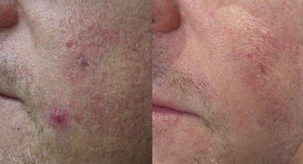 laser-therapy-anti-aging-skincare-brookfield-wi_anti-aging-skin-care-laser-skin-therapy-brookfield-wi-r-shukla laser-therapy-anti-aging-skincare-brookfield-wi_anti-aging-skin-care-laser-skin-therapy-brookfield-wi-r-shukla