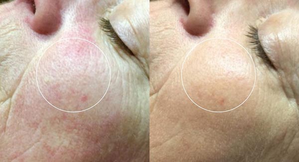 med-spa_celluma-led-light-therapy-anti-aging-skin-care-brookfield-wi med-spa_celluma-led-light-therapy-anti-aging-skin-care-brookfield-wi