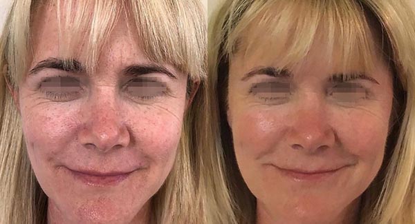 med-spa_celluma-led-light-therapy-anti-aging-skin-care-brookfield-wi5 med-spa_celluma-led-light-therapy-anti-aging-skin-care-brookfield-wi5