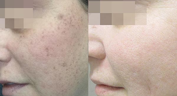 morpheus8-microneedling-anti-aging-skincare-brookfield-wi_anti-aging-skin-care-laser-skin-therapy-brookfield-wi-a-nelson morpheus8-microneedling-anti-aging-skincare-brookfield-wi_anti-aging-skin-care-laser-skin-therapy-brookfield-wi-a-nelson