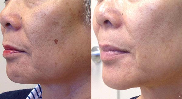 morpheus8-microneedling-anti-aging-skincare-brookfield-wi_anti-aging-skin-care-laser-skin-therapy-brookfield-wi-h-robert morpheus8-microneedling-anti-aging-skincare-brookfield-wi_anti-aging-skin-care-laser-skin-therapy-brookfield-wi-h-robert