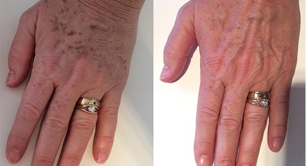 morpheus8-microneedling-anti-aging-skincare-brookfield-wi_anti-aging-skin-care-laser-skin-therapy-brookfield-wi-toni-bur morpheus8-microneedling-anti-aging-skincare-brookfield-wi_anti-aging-skin-care-laser-skin-therapy-brookfield-wi-toni-bur