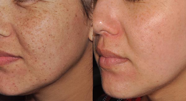 morpheus8-microneedling-anti-aging-skincare-brookfield-wi_anti-aging-skin-care-laser-skin-therapy-brookfield-wi-v-ross morpheus8-microneedling-anti-aging-skincare-brookfield-wi_anti-aging-skin-care-laser-skin-therapy-brookfield-wi-v-ross