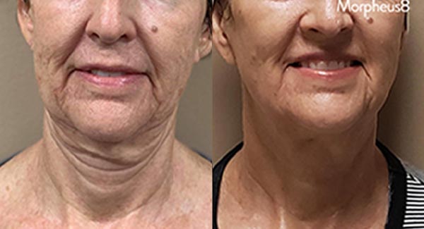 morpheus8-microneedling-anti-aging-skincare-brookfield-wi_anti-aging-skin-care-microneedling-skin-brookfield-wi-laningha