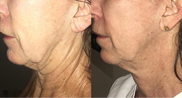 morpheus8-microneedling-anti-aging-skincare-brookfield-wi_anti-aging-skin-care-microneedling-skin-therapy-brookfield-wi-
