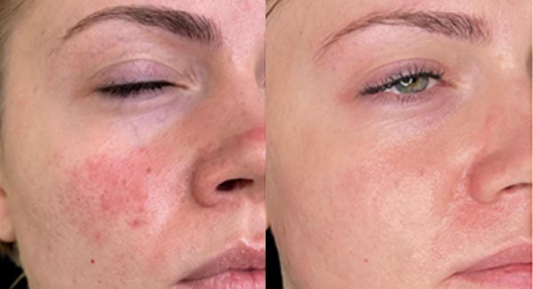 procell-microchanneling-medical-spa_procell-microchanneling-medical-spa_procell-microchanneling-microneedling-anti-aging procell-microchanneling-medical-spa_procell-microchanneling-medical-spa_procell-microchanneling-microneedling-anti-aging