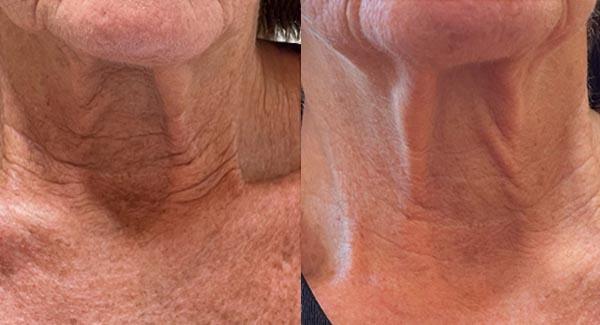 procell-microchanneling-medical-spa_procell-microchanneling-microneedling-anti-aging-medical-spa-brookfield-wi3 procell-microchanneling-medical-spa_procell-microchanneling-microneedling-anti-aging-medical-spa-brookfield-wi