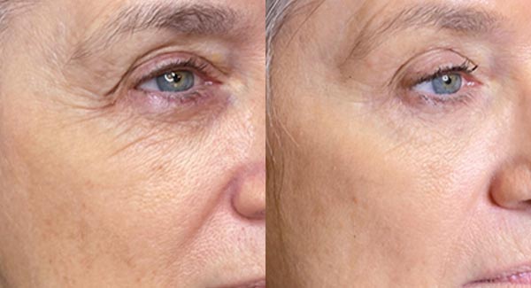 procell-microchanneling-medical-spa_procell-microchanneling-microneedling-anti-aging-medical-spa-brookfield-wi5 procell-microchanneling-medical-spa_procell-microchanneling-microneedling-anti-aging-medical-spa-brookfield-wi