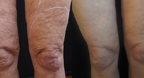 anti-aging-med-spa-brookfield_morpheus8-body-treatments--- anti-aging-medspa-brookfield_morpheus8-body-treatments