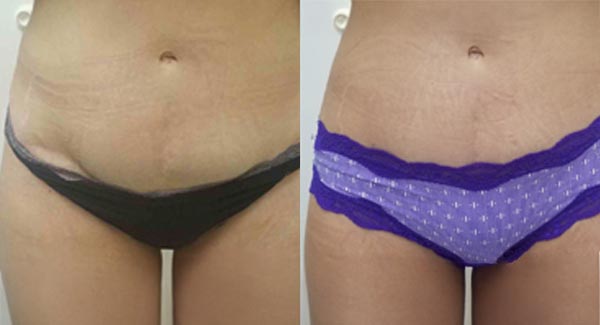 anti-aging-med-spa-brookfield_morpheus8-body-treatments-- anti-aging-medspa-brookfield_morpheus8-body-treatments