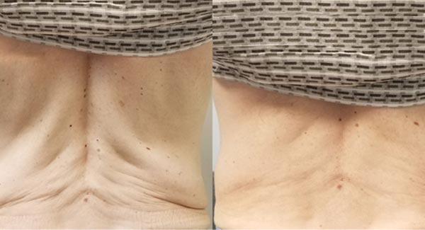 anti-aging-med-spa-brookfield_morpheus8-body-treatments- anti-aging-medspa-brookfield_morpheus8-body-treatments-