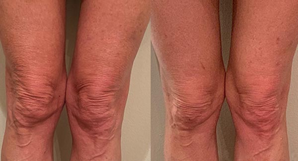 anti-aging-med-spa-brookfield_morpheus8-body-treatments anti-aging-medspa-brookfield_morpheus8-body-treatments